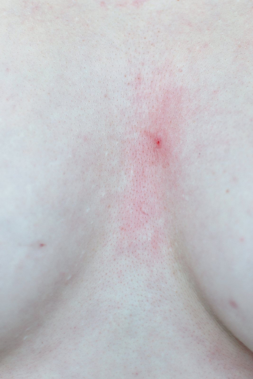 A Pimple on My Chest. From the me(a)ss project, 2017-2020